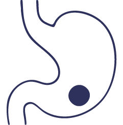 سرطان المعدة